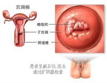 全面解答:17岁宫颈癌能活多久，青年女性健康的关注点