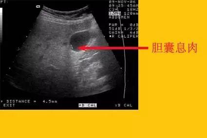 体检查出这6种病不用过度治疗